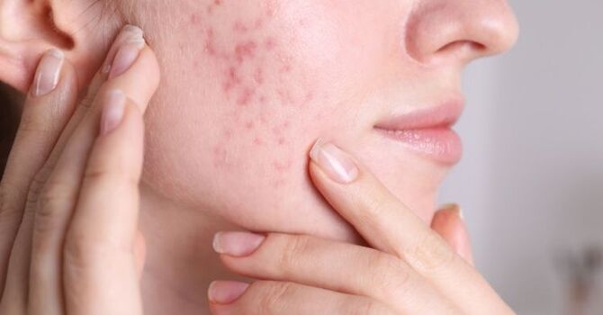 How to Choose the Best Acne Treatment for Your Skin